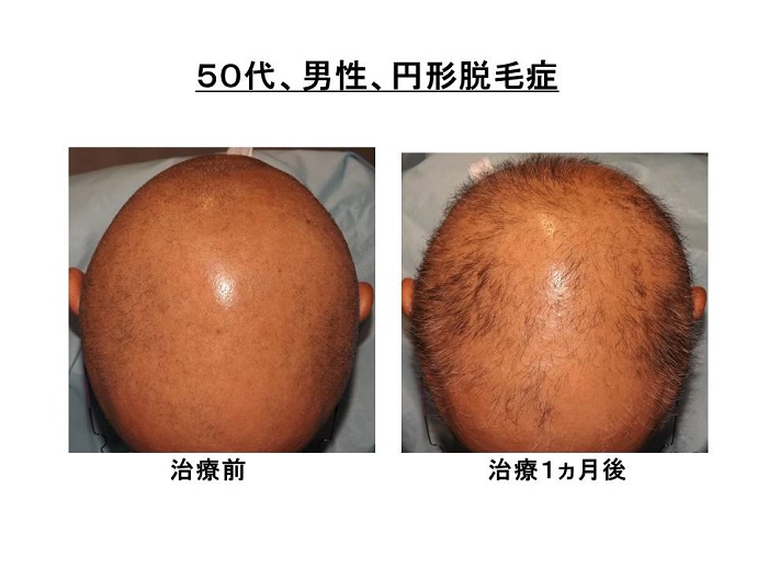 円形脱毛症　病院""
